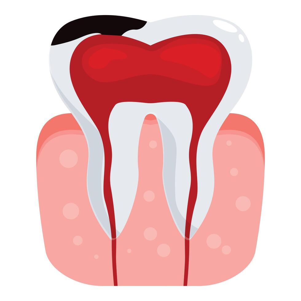 Pulpitis showing inflamed and bleeding tooth pulp chamber with decayed enamel vector