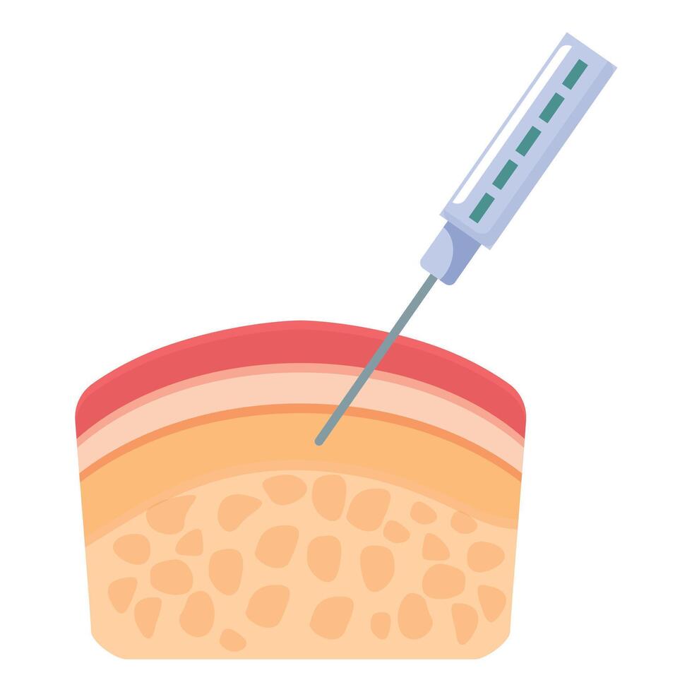 Syringe injecting substance into skin layers, medical procedure illustration vector