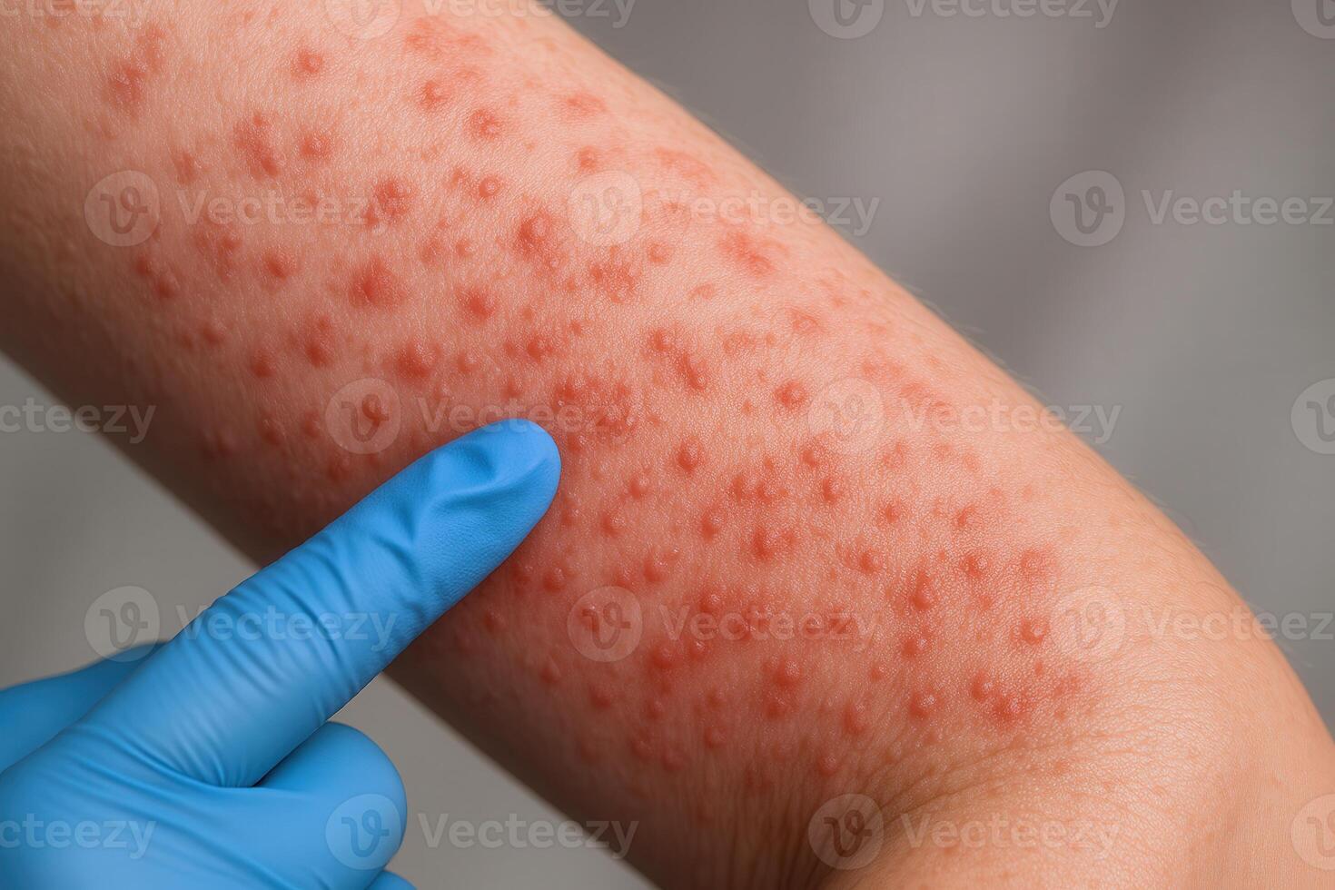 Close-up of allergic skin rash on arm with blue gloved finger pointing photo