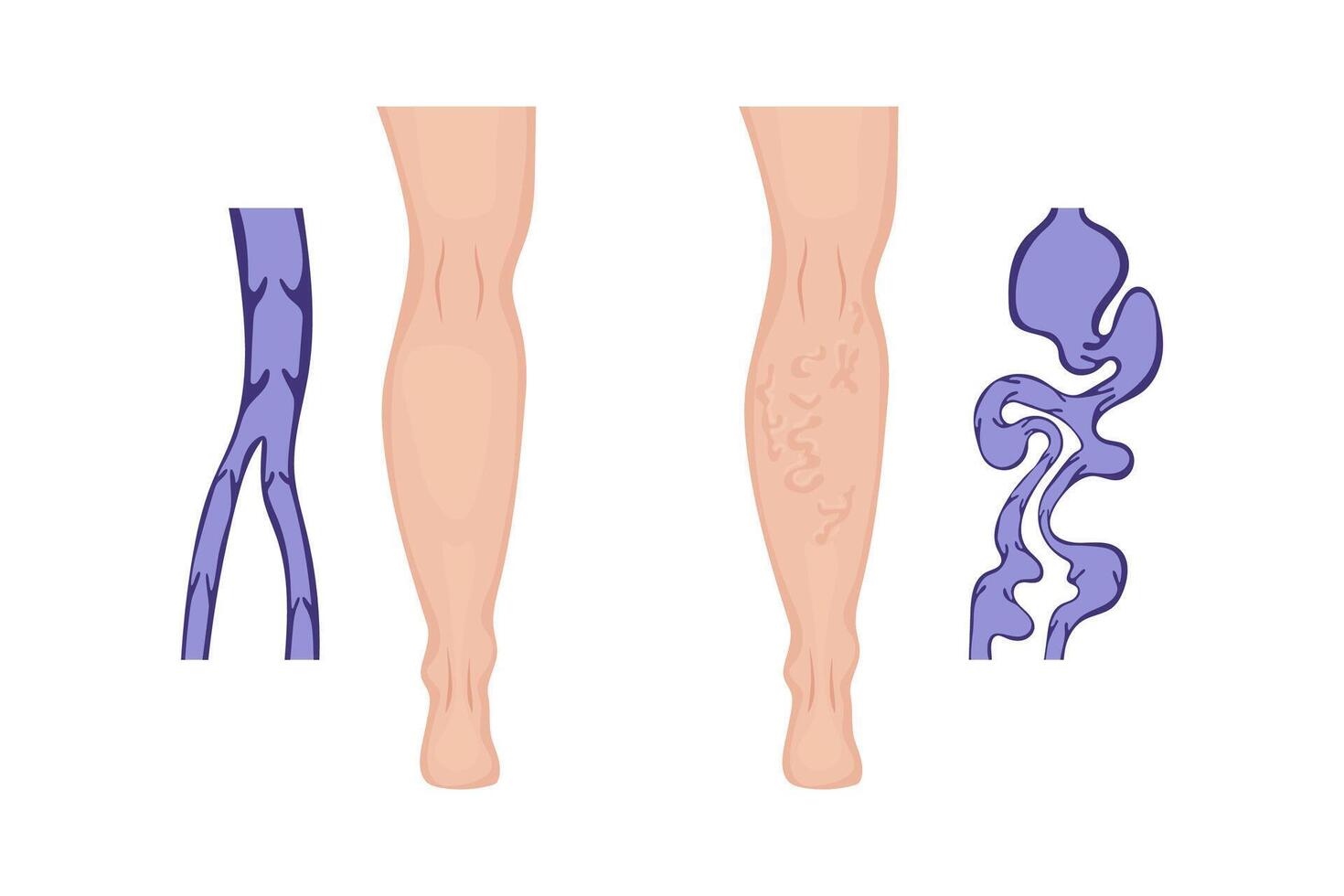 Medical illustration showing healthy leg and varicose veins, providing a clear comparison of normal and abnormal vein structure, highlighting the twisted and enlarged appearance in varicose veins vector