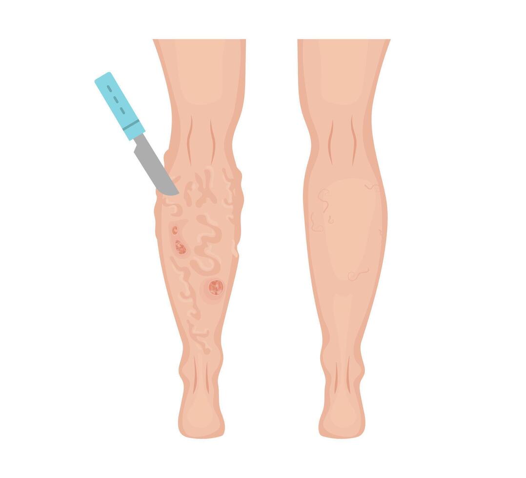 Surgeon removing varicose veins with a scalpel during surgery vector