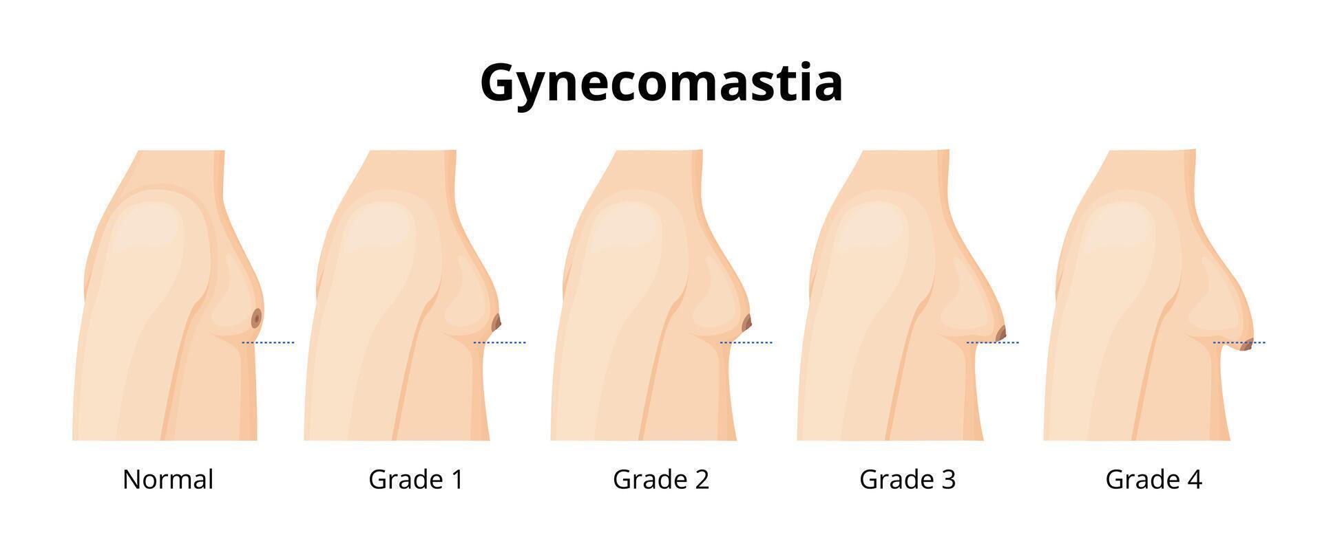 Gynecomastia stages are illustrated, showing the progression of male breast enlargement from normal size to grade four, providing a visual guide for understanding this hormonal condition vector