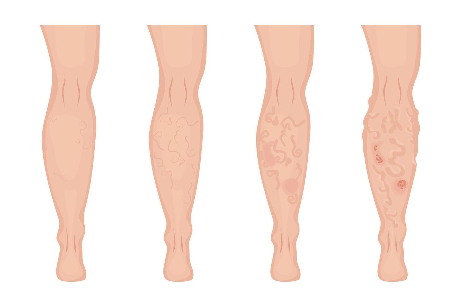 Four steps showing varicose veins gradually appearing on skin, from reticular varicose veins to advanced edema with trophic ulcers, useful for medical and healthcare publications vector