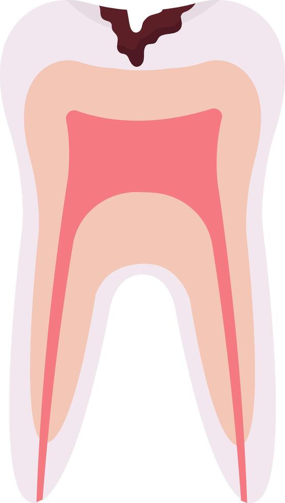 Deep Caries Tooth Problem vector