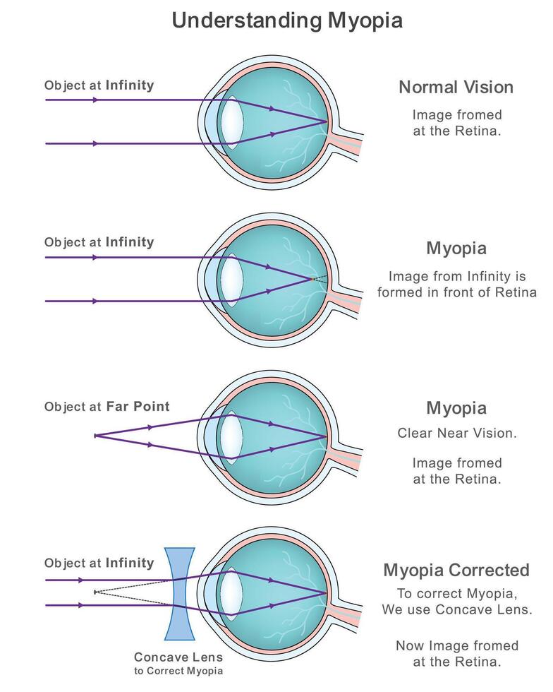 Myopia Explained with Infographic on Normal Vision and Corrective Concave Lens Solutions vector