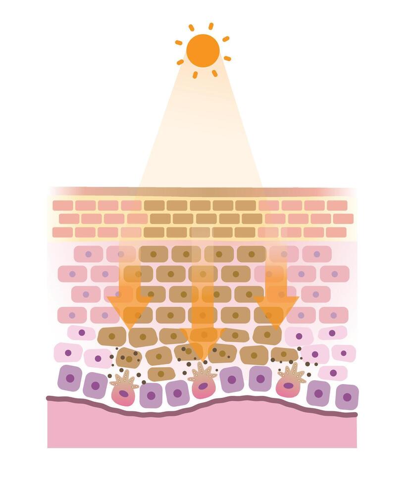 The mechanism of sunspots on skin layer illustration. Cross section of age spots when the skin is exposed to UV rays, the melanin is overproduced, collect into clumps and causing dark spots. vector