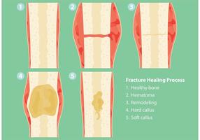 Fractures and Healing Process Vectors