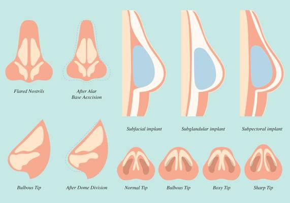 Breast Implant Types Vector & Photo (Free Trial)