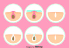 PImple Cleansing Vector