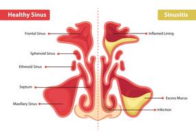 Seno sano y sinusitis vector