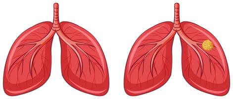 Human lungs and cancer vector