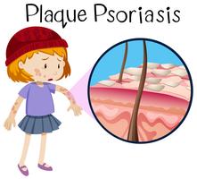 Anatomía humana de la psoriasis en placa vector