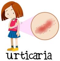 A Young Girl Having Urticaria