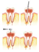 Endodoncia dental vector