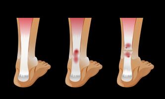 Diagram showing broken bone in human foot vector