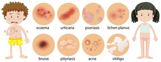 Niños pequeños con diferentes condiciones de la piel. vector