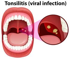 Una infección por amigdalitis en la boca humana vector