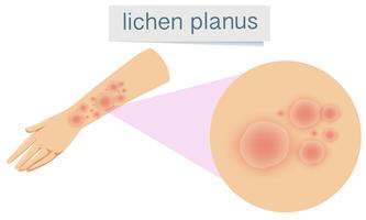 Human Skin with Lichen Planus vector