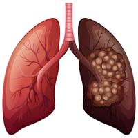 Normal lung and lung cancer vector