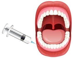 Mouth Anatomy showing Gum Injection vector