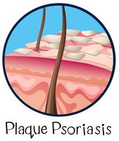 Una anatomía humana placa psoriasis vector