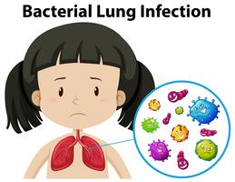 Un vector de infección pulmonar bacteriana
