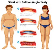 Stent with balloon angioplasty vector