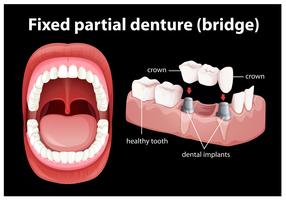 Vector medico de dentadura parcial fija