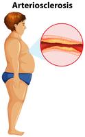 An Overweight Man with Arteriosclerosis vector