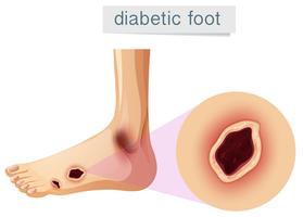 Diabetic foot magnifed on foot vector