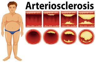 A fat man with atherosclerosis vector