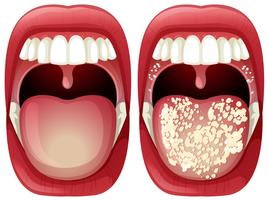 Vector of Healthy and Virus Mouth