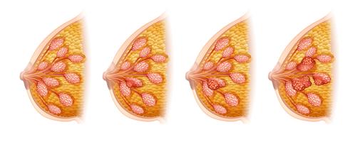 Diagram showing breast cancer in human vector