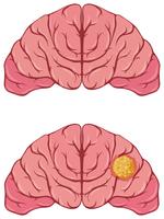 Human brain with cancer vector