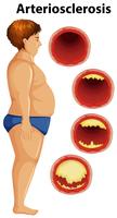 Hombre gordo y arteriosclerosis. vector