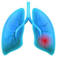 Lung Disease on White Background