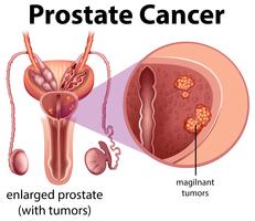 Diagrama de cáncer de próstata masculino vector