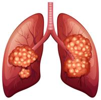 El proceso de cáncer de pulmón en detalle vector