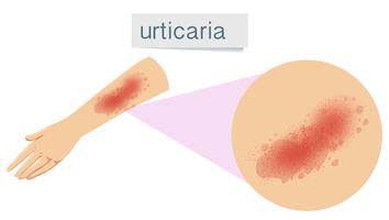 A Human Skin Problem Urticaria vector