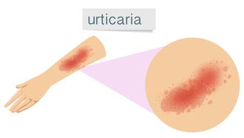 Un problema de la piel humana urticaria vector