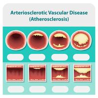 Diagrama que muestra la enfermedad veascular arteriosclerótica vector