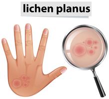 A Human Skin Problem Lichen Planus