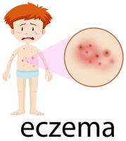 Un niño que tiene eczema en la piel del cuerpo vector