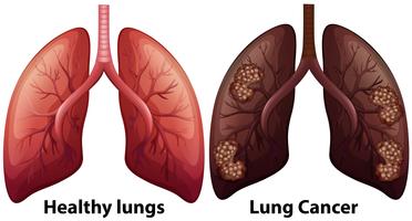 Anatomía humana de la condición pulmonar vector