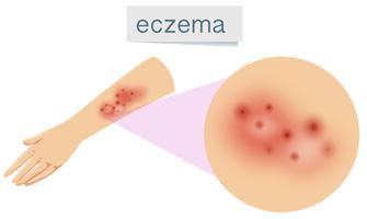 Un vector de eczema en la piel.