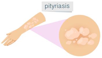 Una pitiriasis en la piel humana vector