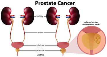 Cáncer de próstata sobre fondo blanco vector