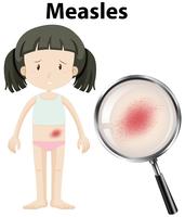 A Girl Having Measles vector