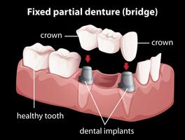 Una dentadura parcial fija. vector