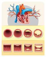 Diagrama que muestra la grasa en el corazón humano vector